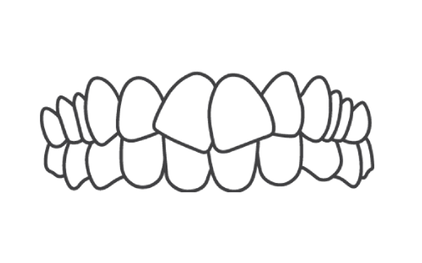Crowded Teeth